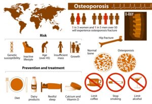The issue of osteoporosis